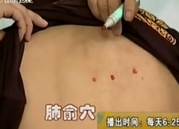 治疗咳嗽的第二个穴位:肺俞穴位图