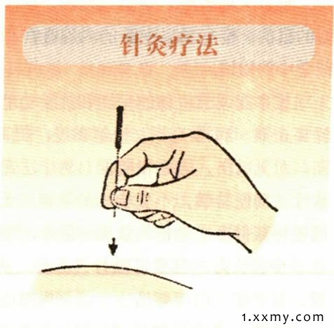 针灸